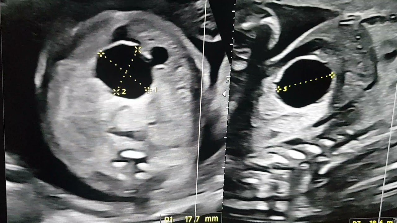 FETAL CHOLEDOCHAL CYST TEACHING BY DR PRADEEP UNDER REFER SERIES