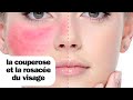 La couperose et la rosace du visage