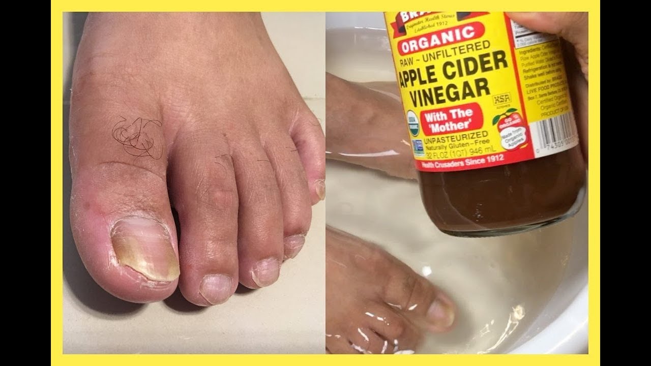 dieta para perder peso y grasa abdominal Si sumerges tus pies en vinagre 1 vez por semanaesto es lo que le pasará a tu cuerpo