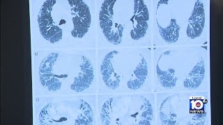 Data indicates there has been a worldwide increase in the incidence of interstitial lung disease