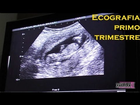 Video: Gli Amici Individuano Il Crocifisso Nell'immagine Del Sonogramma Della Mamma Mom