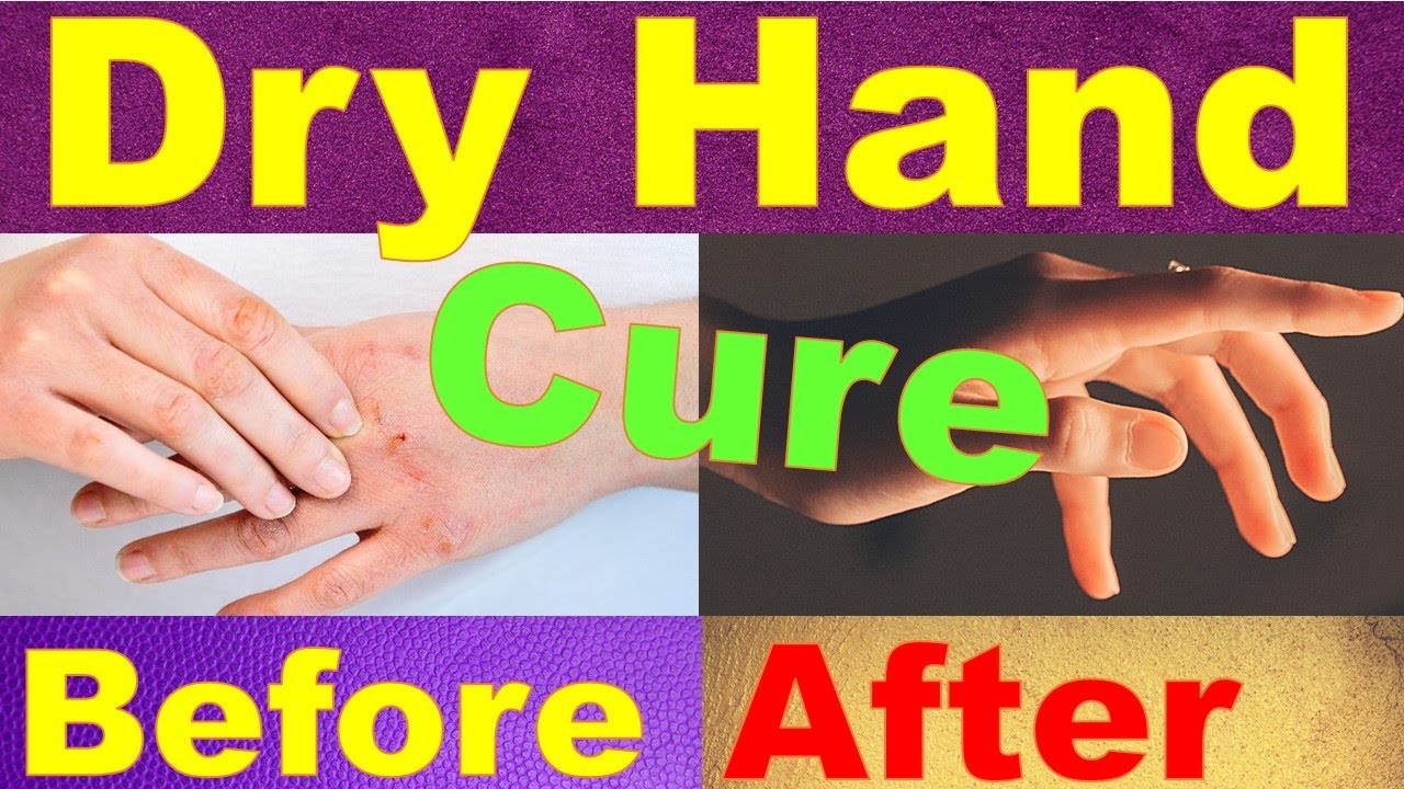 Number 1 Best Remedy for Dry, Rough, and Cracked Hands - YouTube