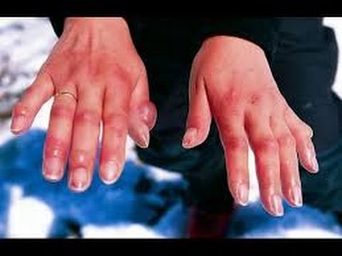 Как лечить опухшие пальцы