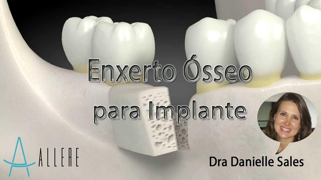 ENXERTO ÓSSEO PARA IMPLANTE DRA DANIELLE SALES YouTube ENXERTO ÓSSEO PARA IMPLANTE DRA DANIELLE SALES YouTube