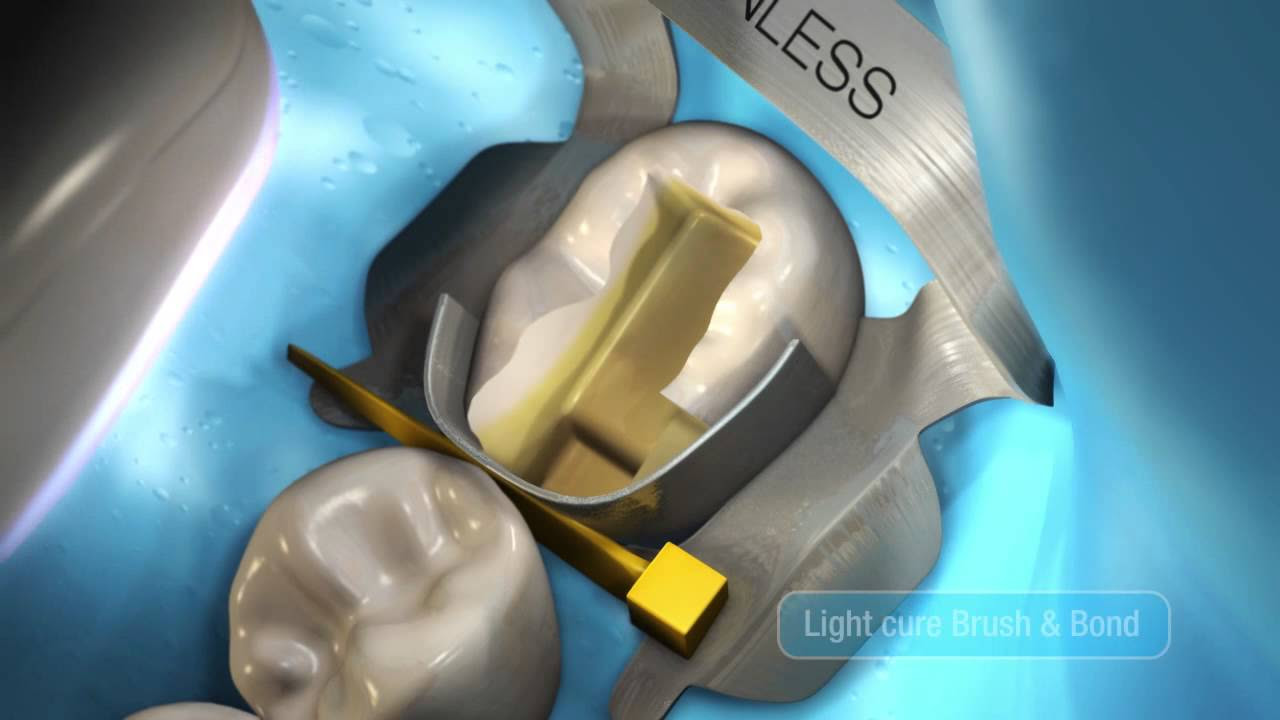 Update Bulk-Fill Composite Restorations using HyperFIL™ and Brush\u0026Bond®.