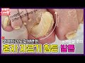 (ENG SUB)두껍고 휘어져서 혼자 자르기 힘든 발톱!  athlete's foot / tinea pedis / onychomycosis - 레푸스 남양주호평점 Refuss