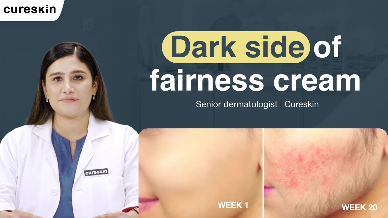Fairness creams can be killing you? | Are there any skin-whitening options - Dermatologist| Cureskin