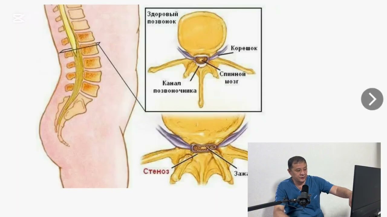 МРТни электрон ва пленкадаги  куриниши , фарклари , умуртка стенози , даволаш , бир беморда тахлил 