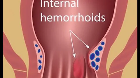 Hemorrhoid Treatment with Colorectal Surgeon Dr. J...