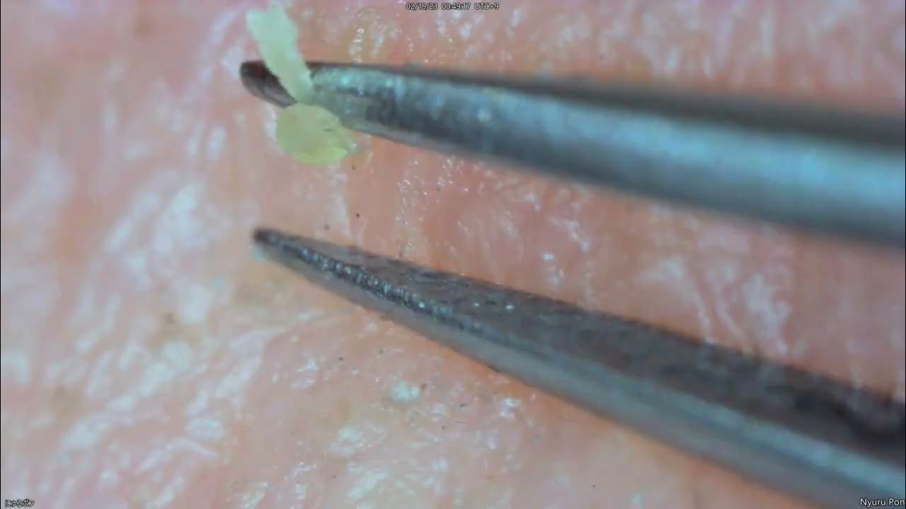 0150 keratin plug removal nose YouTube