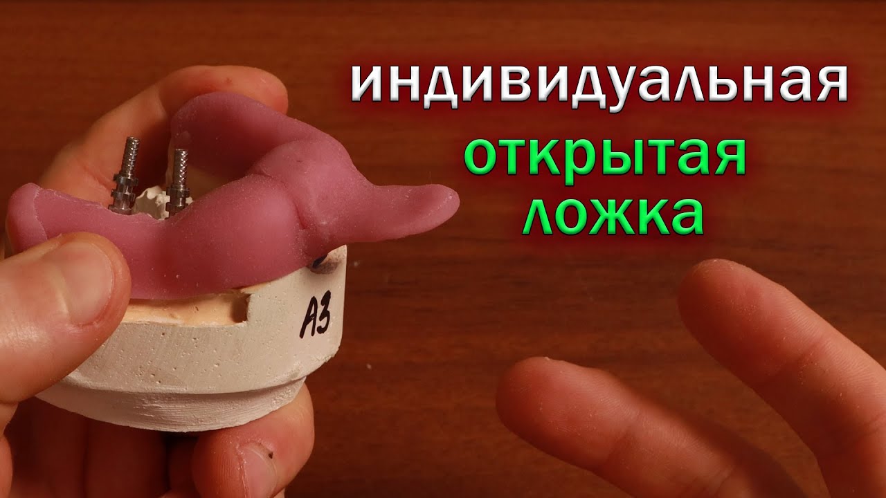 Индивидуальная открытая ложка, снятия слепков с имплантов, шинирование трансферов поверх ложки