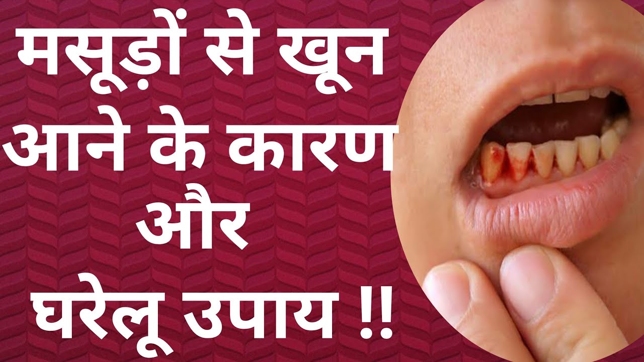 bleeding-gums-home-remedy-reasons-and-home-remedy-for-bleeding-gums