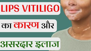 लिप्स विटिलिगो का कारण और इलाज | Lip Vitiligo Natural Treatment in Hindi