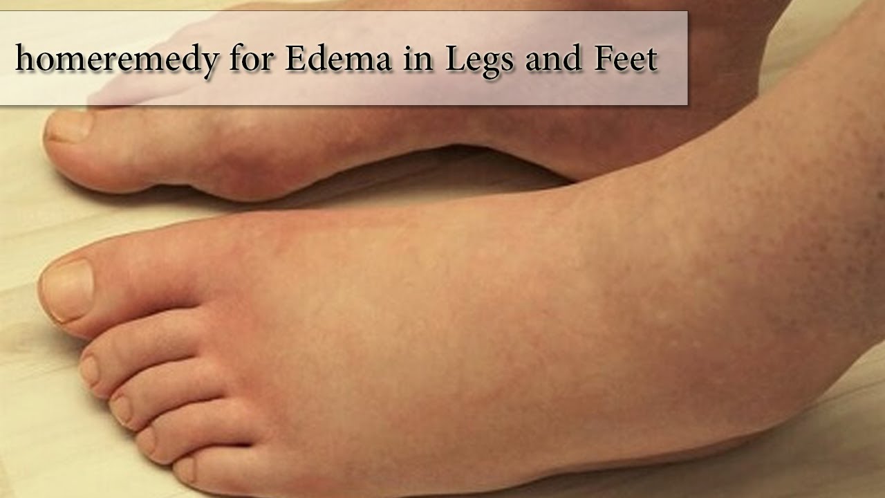 home remedy for edema in legs and feet YouTube