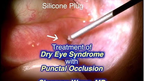 Punctal occlusion for treatment of Dry Eye.  Shannon Wong, MD 11-17-19