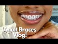 I GOT BRACES! | Braces Vlog 1| Getting Adult Braces