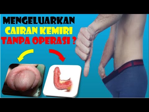 cara-menghilangkan-cairan-suntik-minyak-urang-aring-atau-minyak-kemiri-pada-kemaluan-pria-?