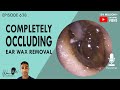 638 - Completely Occluding Ear Wax Removal
