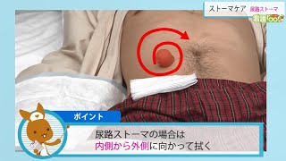 尿路ストーマ装具の交換 | 動画でわかる看護技術 | 看護roo![カンゴルー]