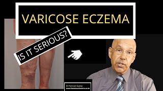 Is Varicose Eczema Serious?