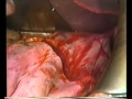 1995 baltasar vary billrothiii vagotomy  antrectomy and rny reconstruction for duodenal ulcer