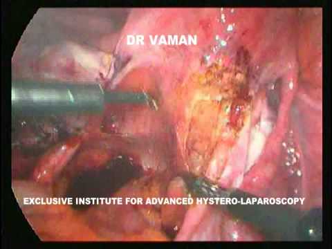 endometriosis urter involved into the adhesions web voice  new 1 OVARIAN CYST