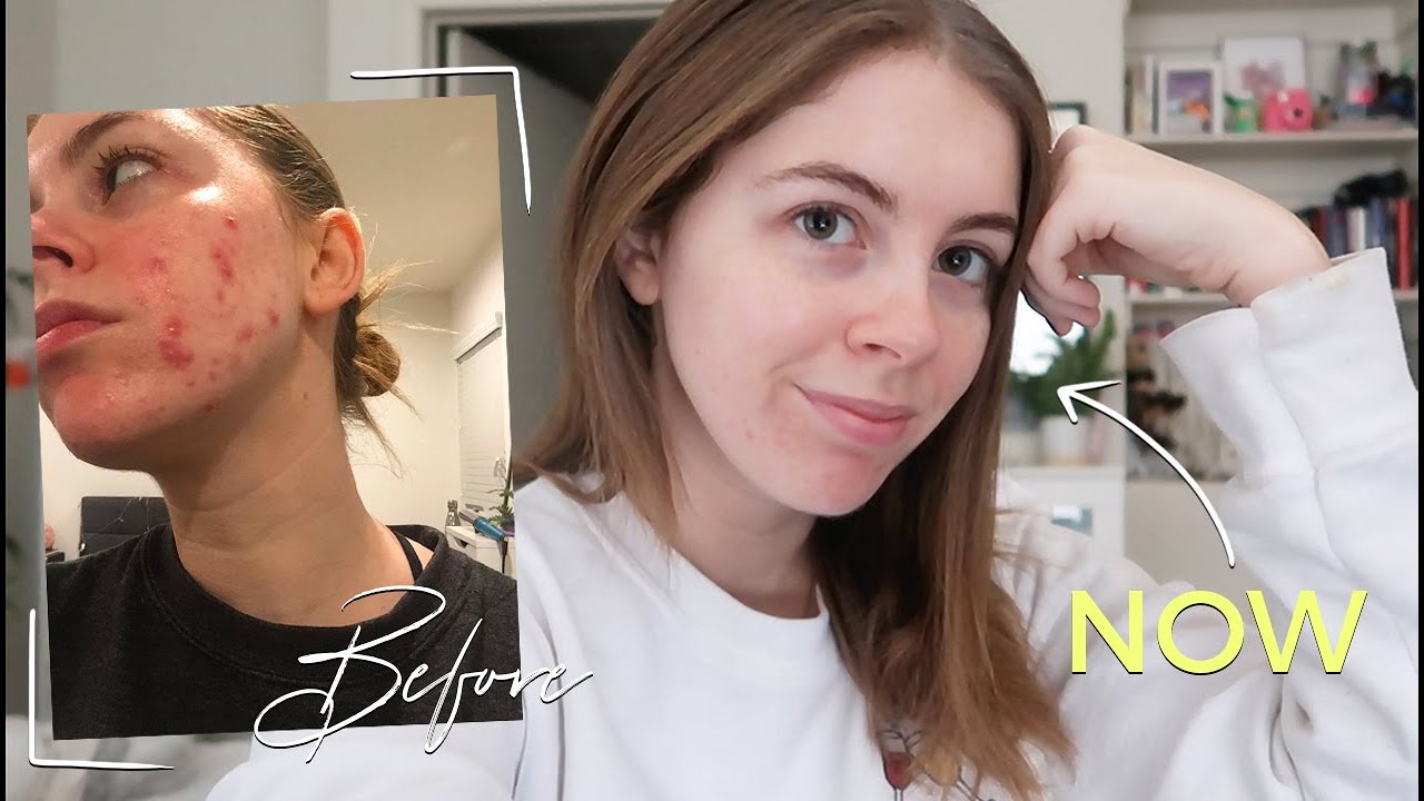How I Cleared My Cystic Acne! My Skincare Routine 2019 Jill Cimorelli