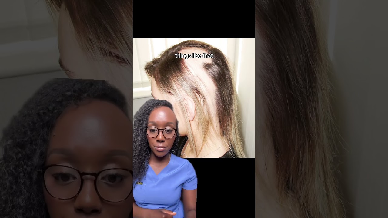 Что такое гнездная алопеция (выпадение волос)? Причины, симптомы, варианты лечения