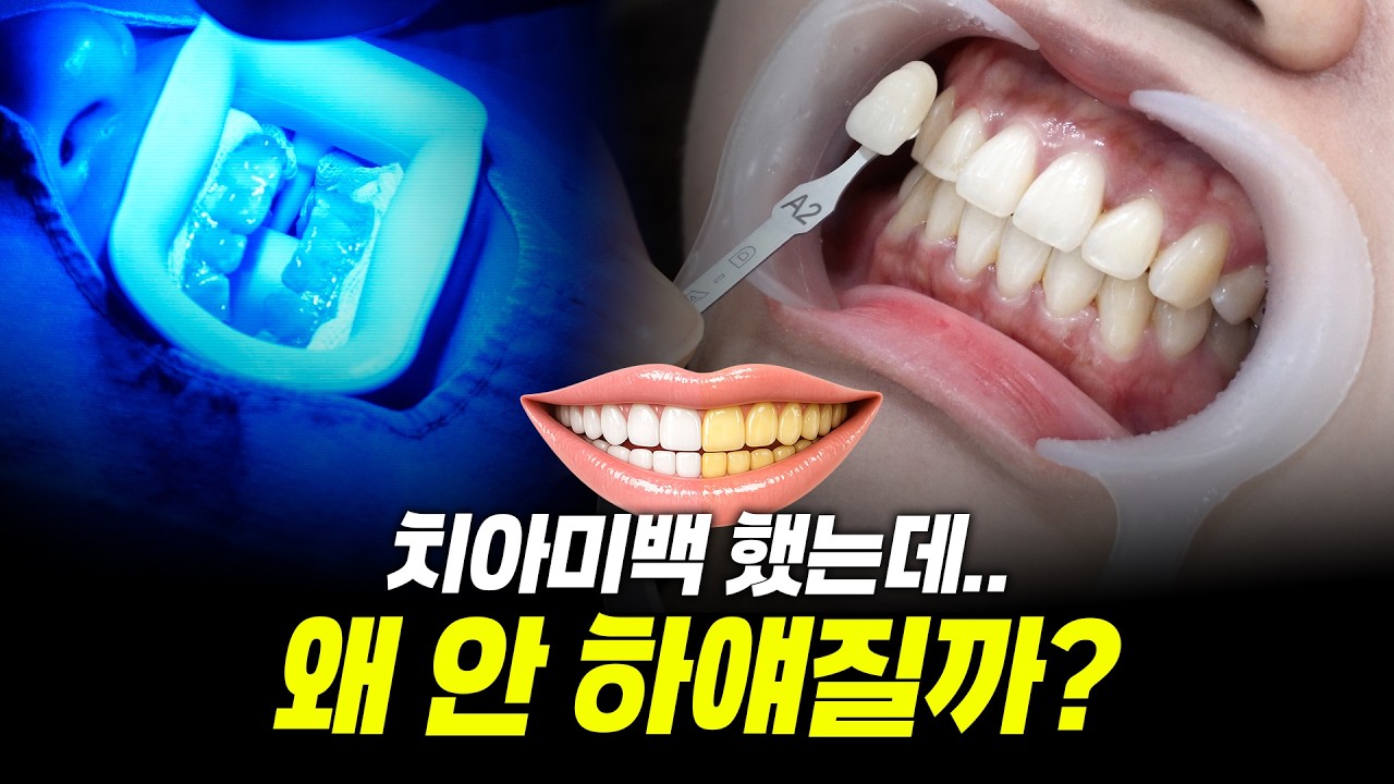 치아미백 효과 없는 사람 특징 📢왜 나만 안 하얘질까?