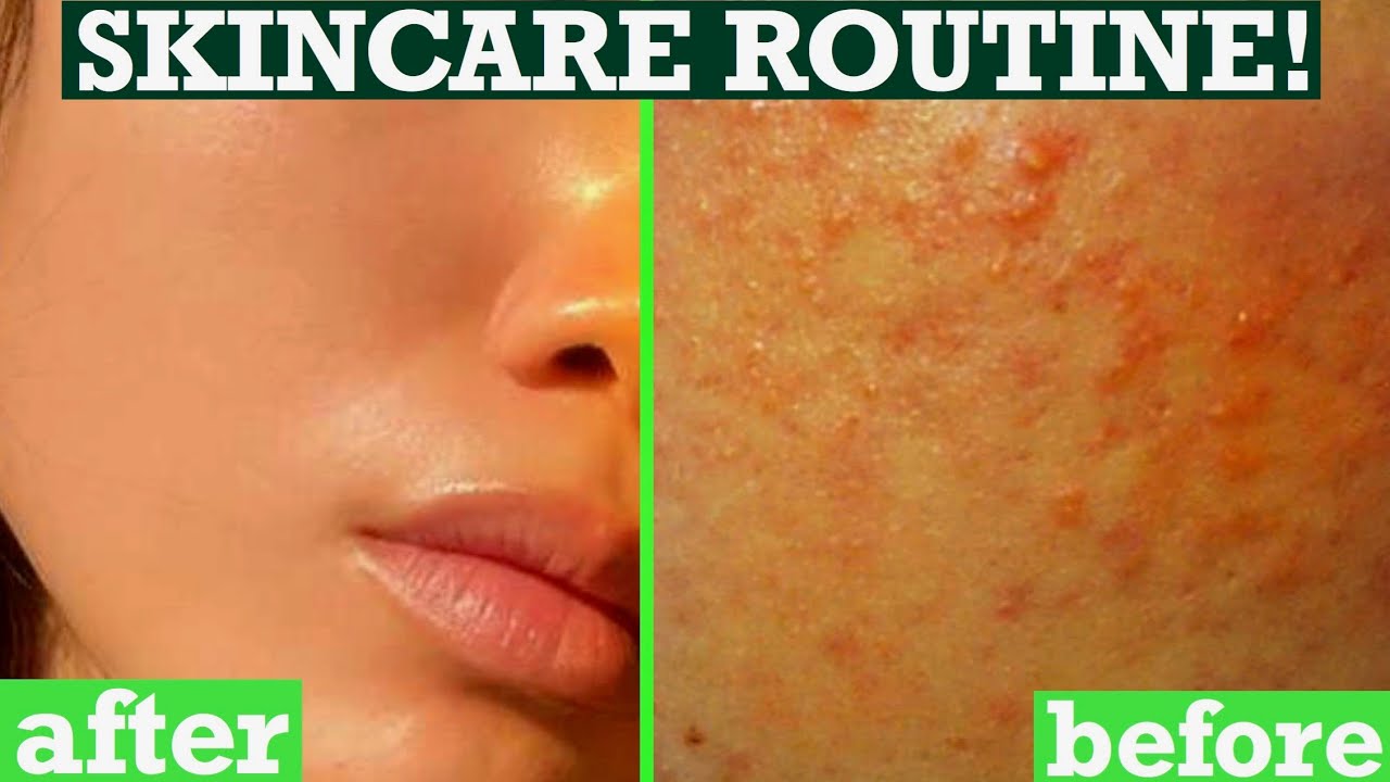 How To Get Rid Of Tiny Bumps On Face Skin Texture Acne Clear Skin