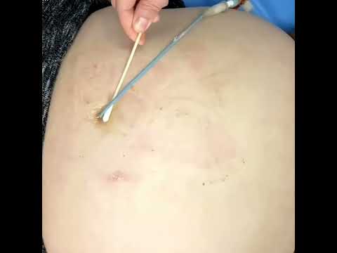 Drainage tubes during transitional care Video S1 500220 by Dove Medical Press