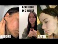 10 YEARS OF ACNE GONE IN 2 WEEKS