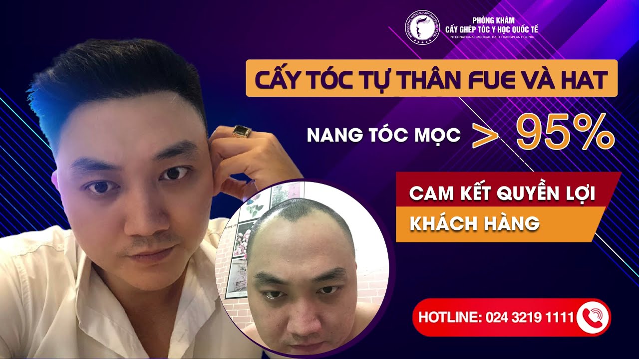 Bật Mí] Cách Trị Tóc Bị Hói 2 Bên Trán Hiệu Quả Trọn Đời