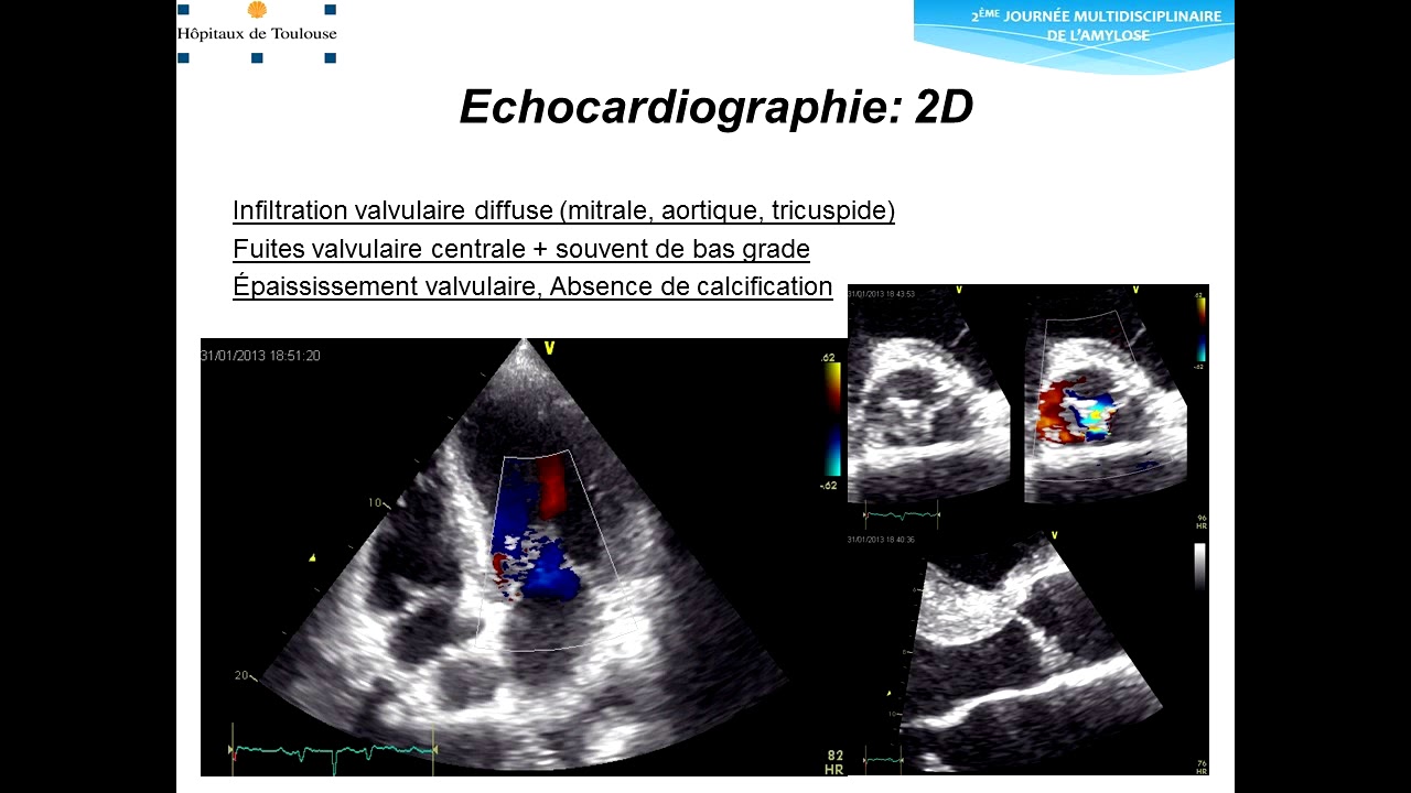 Comment_dépister_les_amyloses_cardiaques?_Matthieu_Berry_JFMA