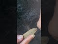 #fypviralシ #statisfying #Lice #hair #LiceOnHead #liceremoval #brasil #xyzbcafyp #licepopping #kutu