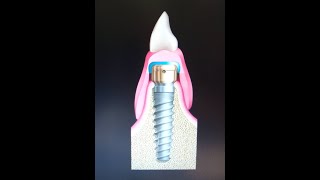 Dentures - Costa Mesa, California - Vanek Dentistry