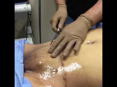 Dallas, TX, Liposuction of the Pubic Area