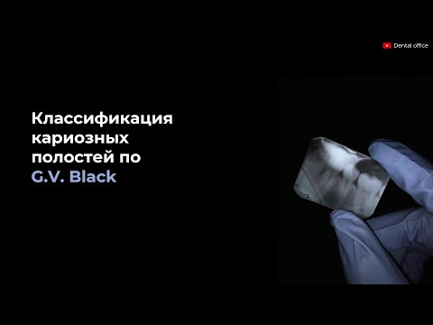 Классификация кариозных полостей по Блэку | G.V. Black's Classification of Carious | Кариесология