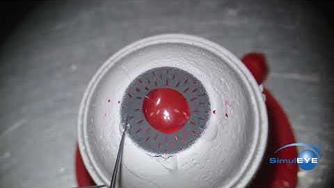 Iris fixation of IOL - Siepser Techinque