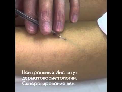 СКЛЕРОЗИРОВАНИЕ ВЕН В Центральный Институт дерматокосметологии