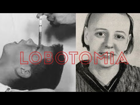 Video: Lobotomia: Un Po 'di Storia E Fotografie Spaventose - Visualizzazione Alternativa