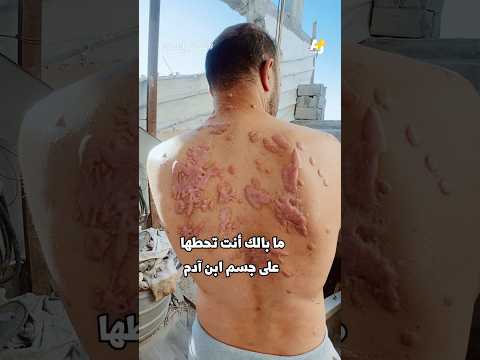 ما الألم الذي شعر به هذا الأسير وهو يعذب بماء النار في جسده وعينه