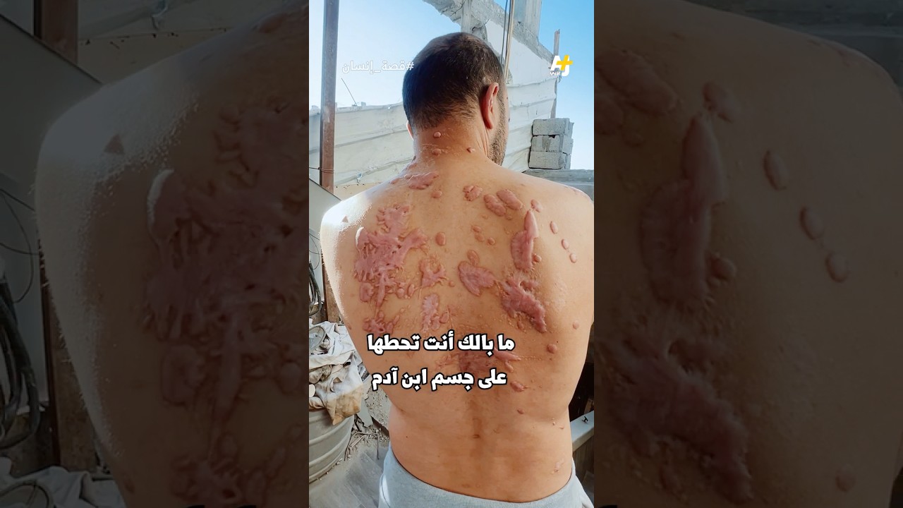 ما الألم الذي شعر به هذا الأسير وهو يعذب بماء النار في جسده وعينه؟