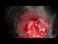 Right Stapedotomy for Extensive Obliterative Otosclerosis done by Dr.Meenesh Juvekar