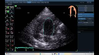 Iq 500 Autoef Lv Echo Pac Analysis Echocardiography