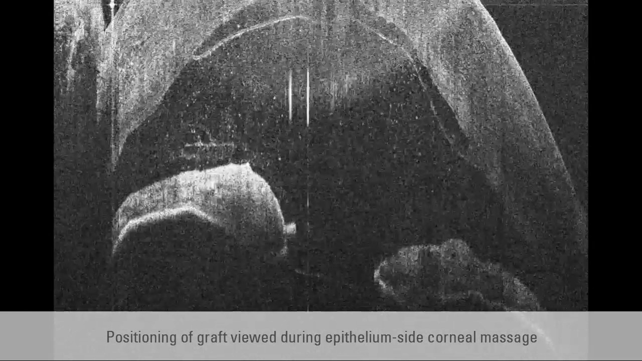 Visualization during DMEK ophthalmic surgery supported by OCT