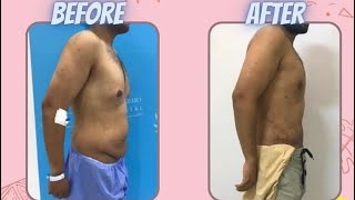 عملية شفط الدهون و التثدى gynecomastia