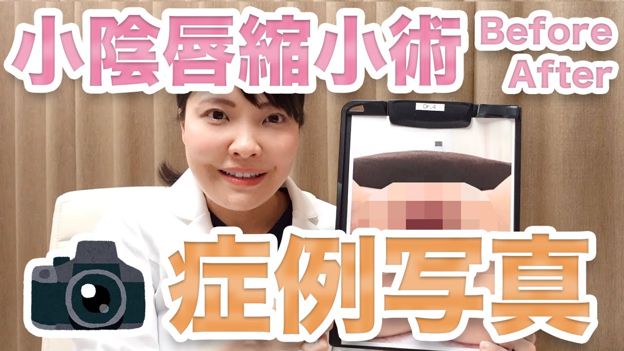 小陰唇縮小術こだわりを症例写真で解説・他院修正【婦人科形成】 Youtube