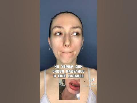 ФИЛЛЕРЫ В ЧЕМ ИХ МИНУС? НЕУДАЧНАЯ ИСТОРИЯ #филеры #фейсбилдинг # ...