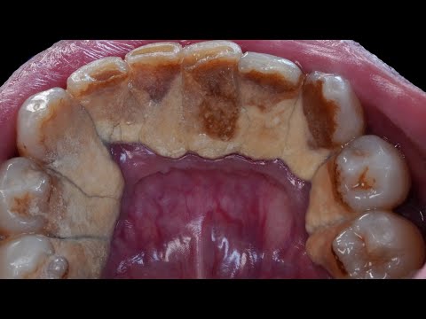 45 yo. Male. Giant Tartar | SCALING | Dentist | Dokter Gigi Tri Putra
